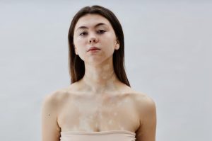 Вітіліго: що це за стан шкіри